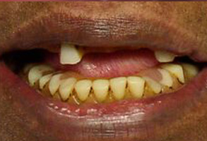 CEREC Dentist in Albany GA